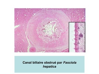 Canal biliaire obstrué par Fasciola
              hepatica
 
