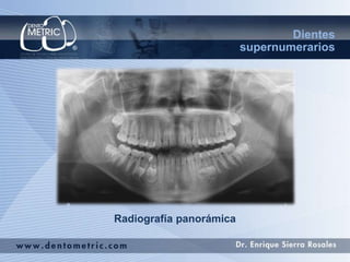 Distomolar | PPTX