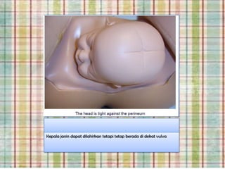 Kepala janin dapat dilahirkan tetapi tetap berada di dekat vulva
 