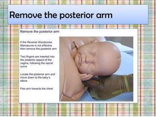 Remove the posterior arm
 