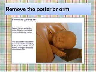 Remove the posterior arm
 