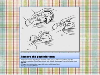 Remove the posterior arm
A. Operator memasukkan tangan kedalam vagina menyusuri humerus posterior janin dan
kemudian melakukan fleksi lengan posterior atas didepan dada dengan mempertahankan posisi
fleksi siku
B. Tangan janin dicekap dan lengan diluruskan melalui wajah janin
C. Lengan posterior dilahirkan
 