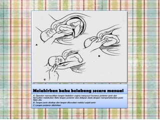 Melahirkan bahu belakang secara manual
A. Operator memasukkan tangan kedalam vagina menyusuri humerus posterior janin dan
kemudian melakukan fleksi lengan posterior atas didepan dada dengan mempertahankan posisi
fleksi siku
B. Tangan janin dicekap dan lengan diluruskan melalui wajah janin
C. Lengan posterior dilahirkan
 