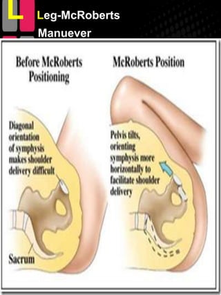 L   Leg-McRoberts
    Manuever
 