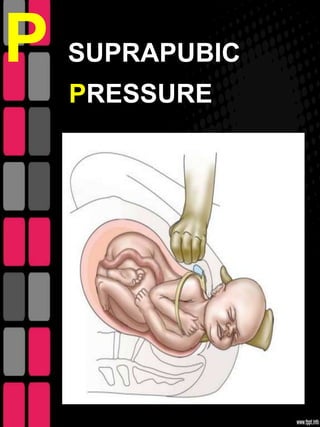 P   SUPRAPUBIC
    PRESSURE
 