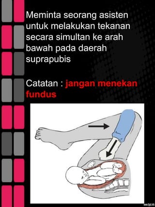 Meminta seorang asisten
untuk melakukan tekanan
secara simultan ke arah
bawah pada daerah
suprapubis

Catatan : jangan menekan
fundus
 