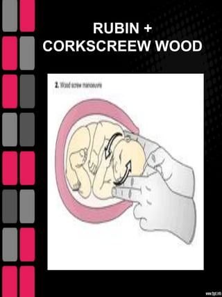 RUBIN +
CORKSCREEW WOOD
 