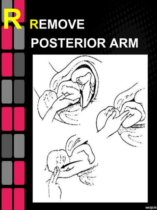 R REMOVE
  POSTERIOR ARM
 