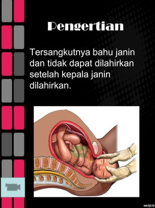 Pengertian
Tersangkutnya bahu janin
dan tidak dapat dilahirkan
setelah kepala janin
dilahirkan.
 