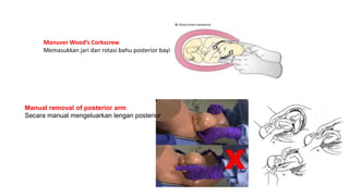 Manuver Wood’s Corkscrew
Memasukkan jari dan rotasi bahu posterior bayi
Manual removal of posterior arm
Secara manual mengeluarkan lengan posterior
 