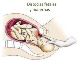 Distocias fetales
y maternas
 