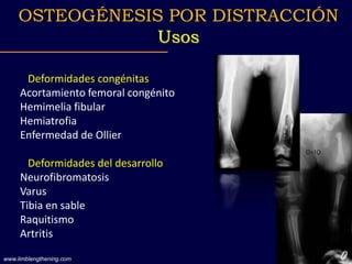 Deformidades congénitas
Acortamiento femoral congénito
Hemimelia fibular
Hemiatrofia
Enfermedad de Ollier
Deformidades del desarrollo
Neurofibromatosis
Varus
Tibia en sable
Raquitismo
Artritis
OSTEOGÉNESIS POR DISTRACCIÓN
Usos
www.limblengthening.com
 