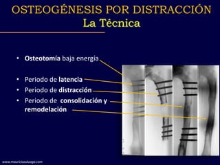 • Osteotomía baja energía
• Periodo de latencia
• Periodo de distracción
• Periodo de consolidación y
remodelación
OSTEOGÉNESIS POR DISTRACCIÓN
La Técnica
www.mauriciozuluaga.com
 