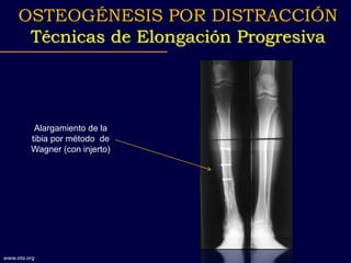 Alargamiento de la
tibia por método de
Wagner (con injerto)
OSTEOGÉNESIS POR DISTRACCIÓN
Técnicas de Elongación Progresiva
www.ota.org
 