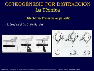 – Método del Dr. G. De Bastiani.
Osteotomía: Preservación periostio
De Bastiani G. Aldegheri R., Renzo B. Limb lenghthening by callus distraction (Callostaxis). J. Pediat. Orthop. 7-129-134. 1987.
OSTEOGÉNESIS POR DISTRACCIÓN
La Técnica
 