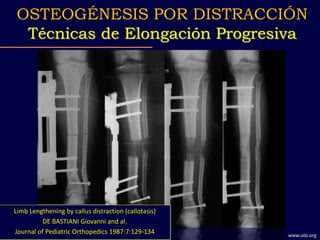 Limb Lengthening by callus distraction (callotasis)
DE BASTIANI Giovanni and al.
Journal of Pediatric Orthopedics 1987:7:129-134
OSTEOGÉNESIS POR DISTRACCIÓN
Técnicas de Elongación Progresiva
www.ota.org
 