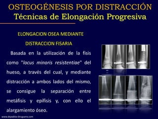 ELONGACION OSEA MEDIANTE
DISTRACCION FISARIA
Basada en la utilización de la fisis
como "locus minoris resistentiae" del
hueso, a través del cual, y mediante
distracción a ambos lados del mismo,
se consigue la separación entre
metáfisis y epífisis y, con ello el
alargamiento óseo.
OSTEOGÉNESIS POR DISTRACCIÓN
Técnicas de Elongación Progresiva
www.depablos-bruguera.com
 