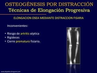 ELONGACION OSEA MEDIANTE DISTRACCION FISARIA
Inconvenientes:
• Riesgo de artritis séptica
• Rigideces
• Cierre prematuro fisiario.
OSTEOGÉNESIS POR DISTRACCIÓN
Técnicas de Elongación Progresiva
www.depablos-bruguera.com
 