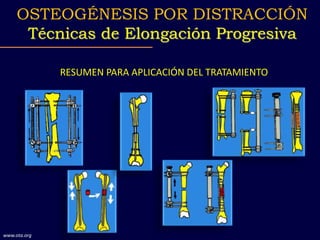 RESUMEN PARA APLICACIÓN DEL TRATAMIENTO
OSTEOGÉNESIS POR DISTRACCIÓN
Técnicas de Elongación Progresiva
www.ota.org
 