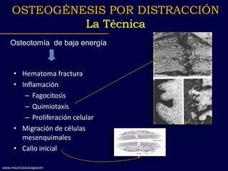 • Hematoma fractura
• Inflamación
– Fagocitosis
– Quimiotaxis
– Proliferación celular
• Migración de células
mesenquimales
• Callo inicial
Osteotomía de baja energía
OSTEOGÉNESIS POR DISTRACCIÓN
La Técnica
www.mauriciozuluagacom
 