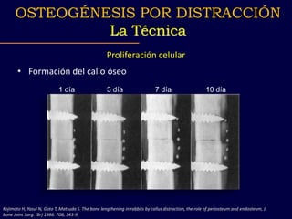 Proliferación celular
• Formación del callo óseo
Kojimoto H, Yasui N, Goto T, Matsuda S. The bone lengthening in rabbits by callus distraction, the role of periosteum and endosteum, J.
Bone Joint Surg. (Br) 1988. 70B, 543-9
1 día 3 día 7 día 10 día
OSTEOGÉNESIS POR DISTRACCIÓN
La Técnica
 