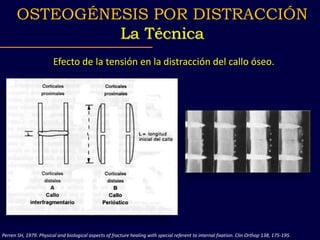 Efecto de la tensión en la distracción del callo óseo.
Perren SH, 1979. Physical and biological aspects of fracture healing with special referent to internal fixation. Clin Orthop 138, 175-195.
OSTEOGÉNESIS POR DISTRACCIÓN
La Técnica
 