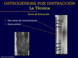 Zonas de distracción
• Dos zonas de mineralización
• Zona central
OSTEOGÉNESIS POR DISTRACCIÓN
La Técnica
www.mauriciozuluagacom
 