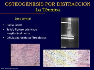 Zona central
• Radio lúcida
• Tejido fibroso orientado
longitudinalmente
• Células parecidas a fibroblastos
OSTEOGÉNESIS POR DISTRACCIÓN
La Técnica
www.mauriciozuluagacom
 