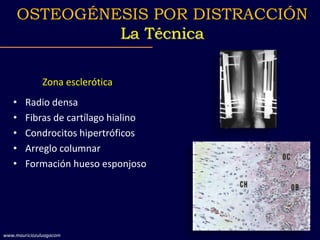 Zona esclerótica
• Radio densa
• Fibras de cartílago hialino
• Condrocitos hipertróficos
• Arreglo columnar
• Formación hueso esponjoso
OSTEOGÉNESIS POR DISTRACCIÓN
La Técnica
www.mauriciozuluagacom
 