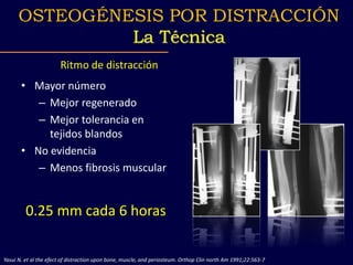Ritmo de distracción
• Mayor número
– Mejor regenerado
– Mejor tolerancia en
tejidos blandos
• No evidencia
– Menos fibrosis muscular
Yasui N. et al the efect of distraction upon bone, muscle, and periosteum. Orthop Clin north Am 1991;22:563-7
0.25 mm cada 6 horas
OSTEOGÉNESIS POR DISTRACCIÓN
La Técnica
 