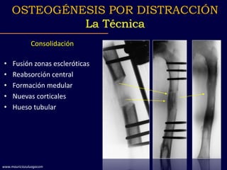 Consolidación
• Fusión zonas escleróticas
• Reabsorción central
• Formación medular
• Nuevas corticales
• Hueso tubular
OSTEOGÉNESIS POR DISTRACCIÓN
La Técnica
www.mauriciozuluagacom
 