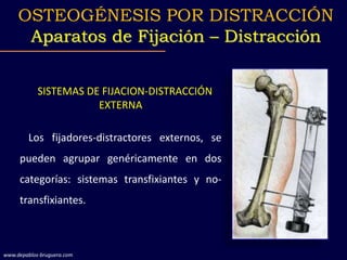 SISTEMAS DE FIJACION-DISTRACCIÓN
EXTERNA
Los fijadores-distractores externos, se
pueden agrupar genéricamente en dos
categorías: sistemas transfixiantes y no-
transfixiantes.
OSTEOGÉNESIS POR DISTRACCIÓN
Aparatos de Fijación – Distracción
www.depablos-bruguera.com
 