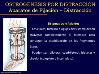 Sistemas transfixiantes
Los clavos, tornillos o agujas del sistema deben
atravesar completamente el miembro para
conseguir la estabilización de los fragmentos
óseos.
Pueden ser: bilateral, cuadrilateral, biplanar y
circular (completo o incompleto).
OSTEOGÉNESIS POR DISTRACCIÓN
Aparatos de Fijación – Distracción
www.depablos-bruguera.com
 