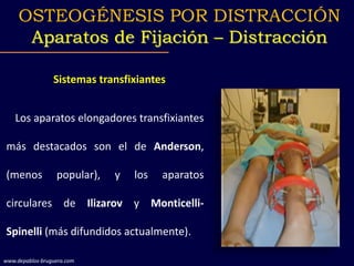 Sistemas transfixiantes
Los aparatos elongadores transfixiantes
más destacados son el de Anderson,
(menos popular), y los aparatos
circulares de Ilizarov y Monticelli-
Spinelli (más difundidos actualmente).
OSTEOGÉNESIS POR DISTRACCIÓN
Aparatos de Fijación – Distracción
www.depablos-bruguera.com
 