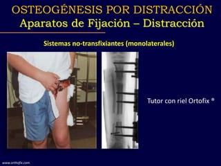 Sistemas no-transfixiantes (monolaterales)
OSTEOGÉNESIS POR DISTRACCIÓN
Aparatos de Fijación – Distracción
www.orthofix.com
Tutor con riel Ortofix ®
 