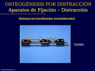 Sistemas no-transfixiantes (monolaterales)
OSTEOGÉNESIS POR DISTRACCIÓN
Aparatos de Fijación – Distracción
www.howmedica.com
TO5000
 
