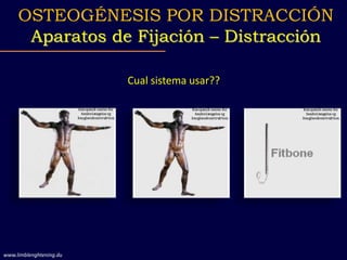Cual sistema usar??
OSTEOGÉNESIS POR DISTRACCIÓN
Aparatos de Fijación – Distracción
www.limblenghtening.du
 