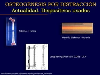 http://www.shortsupport.org/Health/Leg-Lengthening/new_devel.html/
OSTEOGÉNESIS POR DISTRACCIÓN
Actualidad. Dispositivos usados
Albizzia - Francia
Método Bliskunov - Ucrania
Lengthening Over Nails (LON) - USA
 