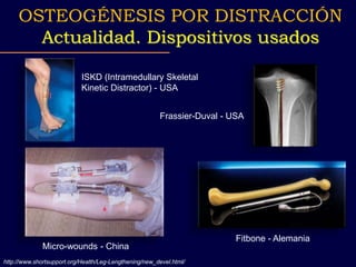 http://www.shortsupport.org/Health/Leg-Lengthening/new_devel.html/
OSTEOGÉNESIS POR DISTRACCIÓN
Actualidad. Dispositivos usados
ISKD (Intramedullary Skeletal
Kinetic Distractor) - USA
Micro-wounds - China
Fitbone - Alemania
Frassier-Duval - USA
 
