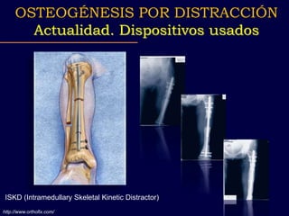 http://www.orthofix.com/
ISKD (Intramedullary Skeletal Kinetic Distractor)
OSTEOGÉNESIS POR DISTRACCIÓN
Actualidad. Dispositivos usados
 