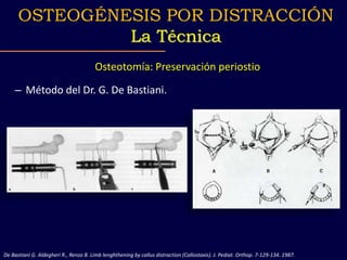 – Método del Dr. G. De Bastiani.
Osteotomía: Preservación periostio
De Bastiani G. Aldegheri R., Renzo B. Limb lenghthenin...