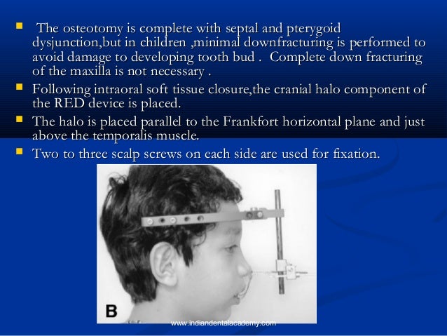 distraction osteogenesis for correcting skeletal dysplasia the application of a cranial halo is a form of