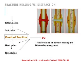 DISTRACTION osteogenesis provedure).pptx