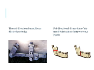 Injection Distraction DISTRACTION osteogenesis provedure).pptx