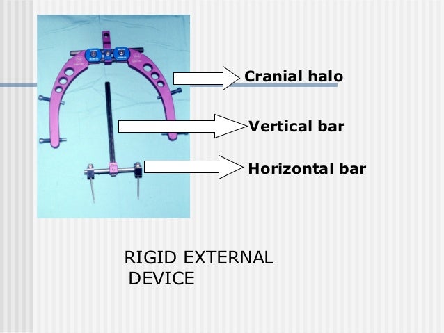 distraction osteogenesis the application of a cranial halo is a form of