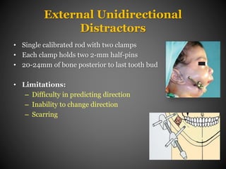 Distraction osteogenesis | PPTX