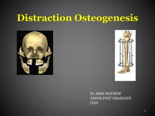 Distraction Osteogenesis
1
Dr. ABIN MATHEW
2NDYR POST GRADUATE
CIDS
 