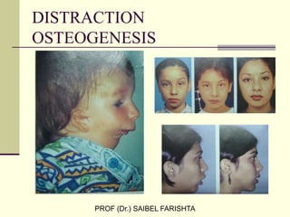 DISTRACTION
OSTEOGENESIS
PROF (Dr.) SAIBEL FARISHTA
 