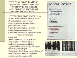 Distraction Osteogenesis | PPT