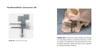 Maxillomandibular Advancement DO
 